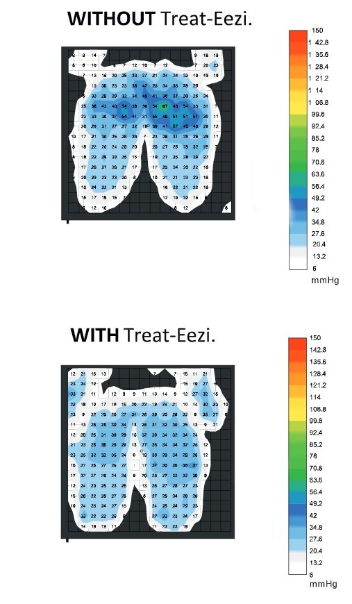 A pressure distribution map of the effect of the treat-eezi overlay on pressure sores