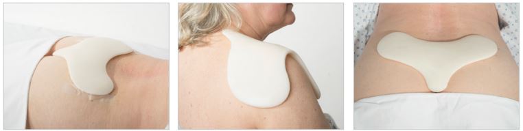The DermisPlus Sacrum Pad can be used on the sacral area, ankle, and shoulder DermisPlus Sacrum Pad For Sacral Area, Shoulder, And Ankle